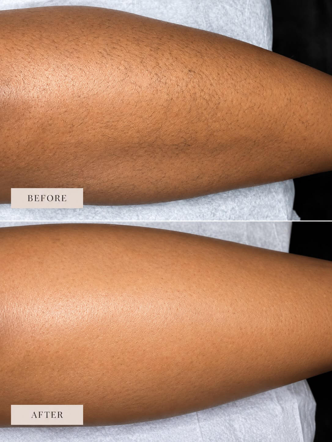 before and after image of leg hair removed by cane sugaring